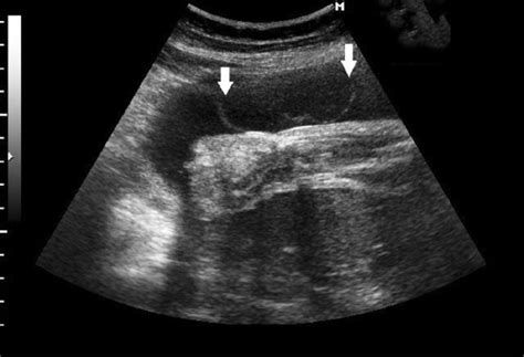 Two Dimensional Ultrasonography Shows Adherence Of Two Amniotic Bands