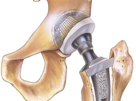 New Regulations On Metal On Metal Hip Implants In Europe East