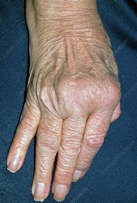 Rheumatoid Arthritis Of Hand With Ulnar Deviation Stock Image M110