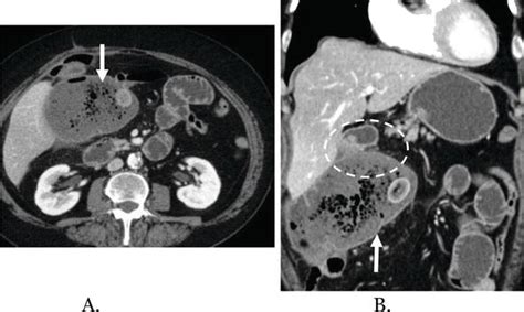 Imaging Of Constipation And Its Complications Intechopen
