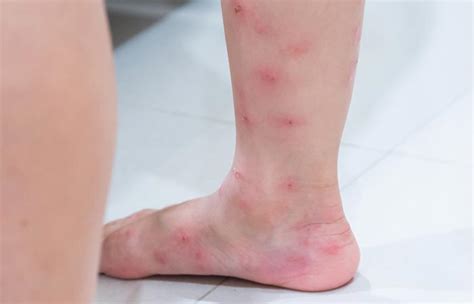 7 Home Remedies For Bug Bites Signs Symptoms And Risk Factors
