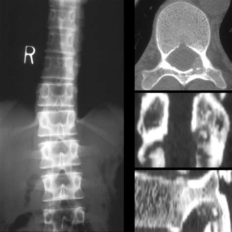 Painful Scoliosis Pediatric Radiology Reference Article Pediatric