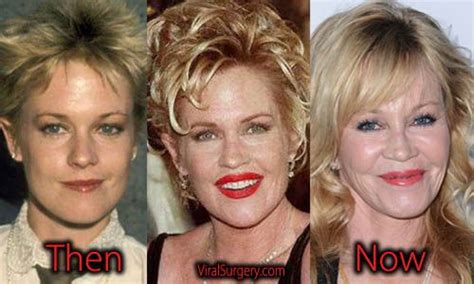 Melanie Griffith Plastic Surgery, Before and After Photos ...