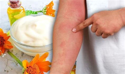 eczema treatment prevent dry and itchy skin with a calendula cream moisturiser uk
