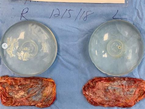 What Breast Implants Look Like After Theyve Been Removed