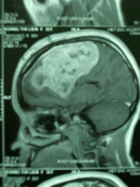 The first step in detecting a brain tumor is to recognize the symptoms. Dental X Rays Safe While Breastfeeding - Find Local ...