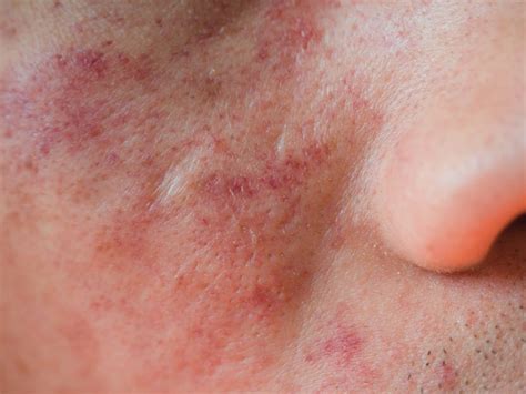 Eczema On The Face Symptoms Causes Diagnosis Treatment