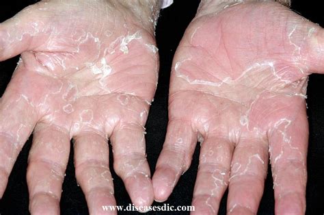 Peeling Skin Syndrome Definition Treatment And Prevention