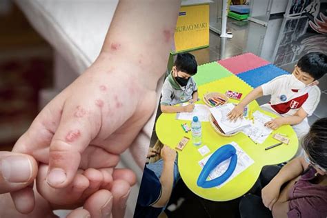 Virus Coxsackie Comment Prévenir Les Infections Chez Les Enfants Infobae