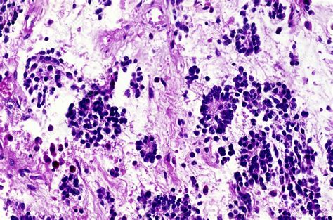 Neuroblastoma Light Micrograph Stock Image C0035536 Science