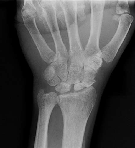 Scaphoid Nonunion Advanced Collapse Snac Hand Orthobullets