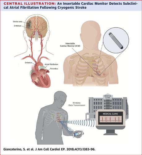 Current And Future Use Of Insertable Cardiac Monitors Jacc Clinical