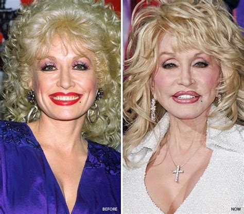 Dolly Parton Plastic Surgery Before and After Breast ...