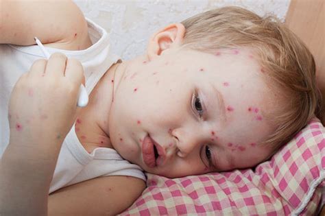 Chickenpox causes detect (a rash) and can make a youngster feel commonly unwell. Top 10 Home Remedies for Natural Chicken Pox Treatment ...