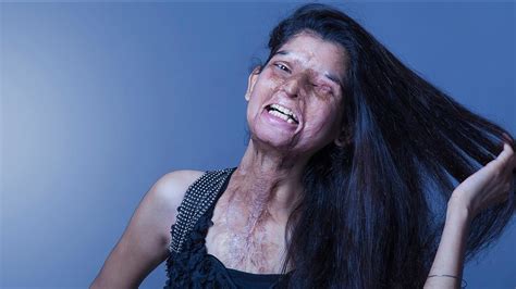 Acid Victims Photo Shoot Draws Attention In India Abc13 Houston