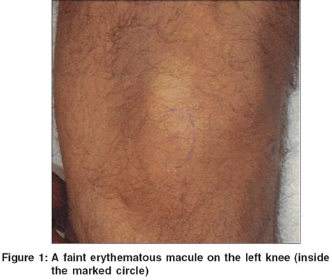 Solitary Painful Red Macule Over Left Knee Indian Journal Of Dermatology Venereology And