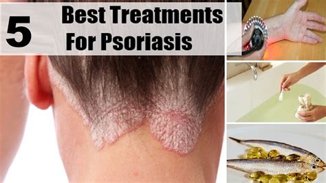 5 Home Remedies For Psoriasis By Top 5 Youtube