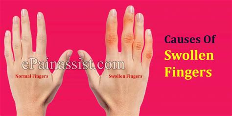 Causes Of Swollen Fingers