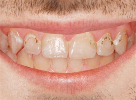 Treatment Of “white Spot Lesions” After Removal Of Fixed Orthodontic