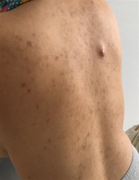 Skin Concerns Ive Had Acne On My Back For 5 6 Years Now These Are