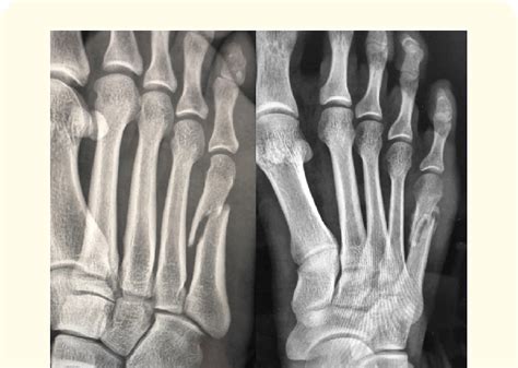 X Ray 1 Dislocated Right Fifth Metatarsal Bone Shaft Fracture 2 After Download Scientific