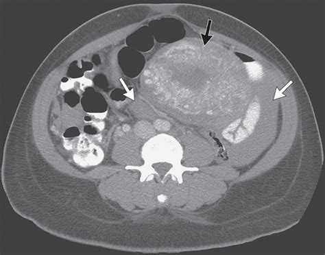 Case 32 2010 — A Pregnant Woman With Abdominal Pain And Fluid In The