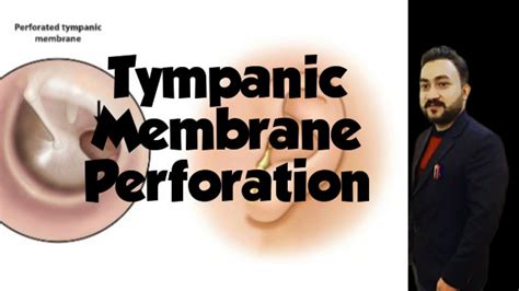 Tympanic Membrane Perforation Youtube