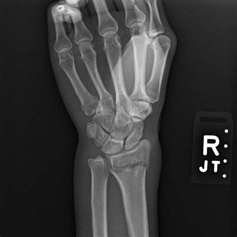 Broken Wrist Buyxraysonline