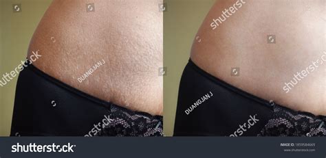 Image Before After Skin Stretch Marks Foto Stock Editar Agora 1859584669