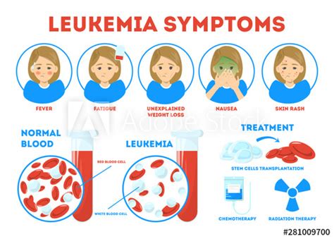 Leukemia Scientists Discover Potential New Method For Treating Acute