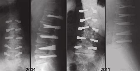 A 50 Year Old Female Patient With Degenerative Scoliosis And Back Pain