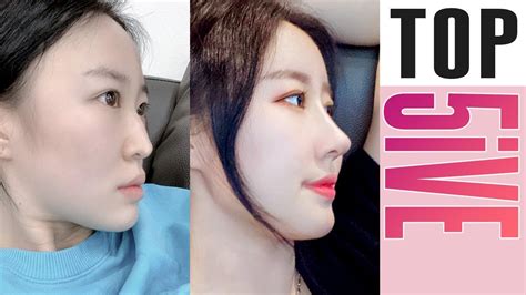 Sub Top Dramatic Korean Plastic Surgery Before After Change