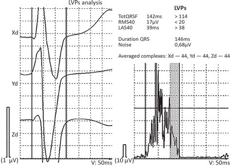 Signal Averaged Ecg In The Patient Positivity Criteria For Late