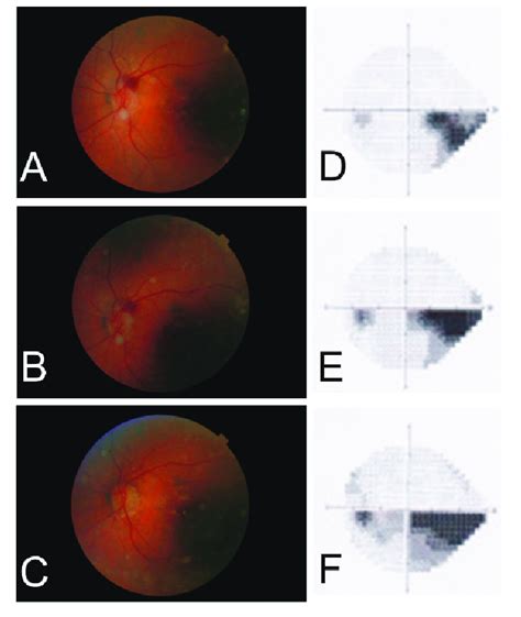 A Series Of Fundus Photographs And Humphrey Visual Fields 24 2