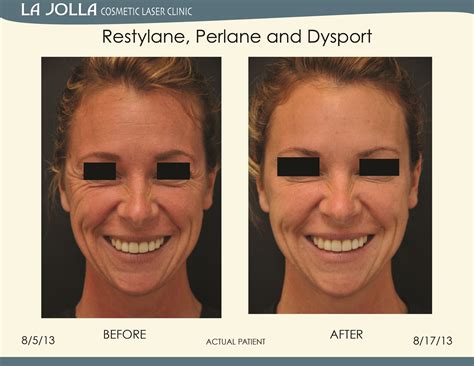 Patient Treated With Restylane Perlane And Dysport At La Jolla