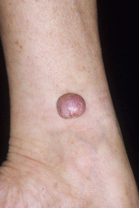 October 2014 Case Of The Month Beautiful Skin Skin Dermatology