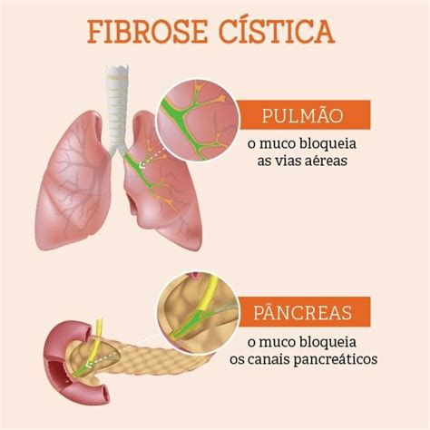 Cystic fibrosis is a hereditary disease that causes the body to produce thick and sticky mucus that can clog the lungs and obstruct the pancreas. PET Enfermagem - UFG/CAJVOCÊ SABE O QUE É FIBROSE CÍSTICA?