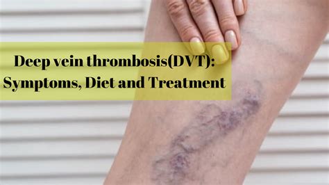 Deep Vein Thrombosis Symptoms Diet And Treatment