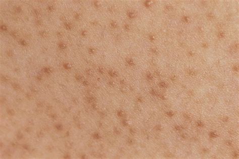 Aha Or Bha For Keratosis Pilaris Which Is Effective Skincare Weeklies