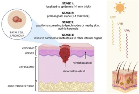 Studying Medicine On Twitter Basal Cell Skin Carcinoma Low