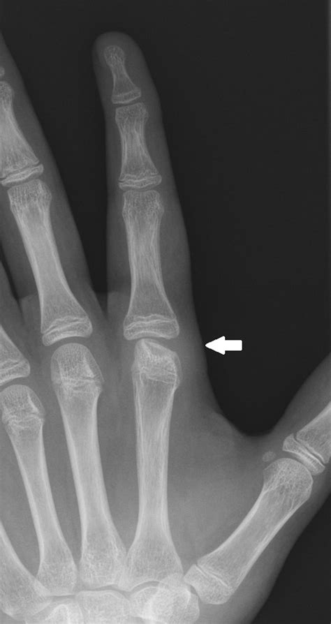 Persisting Isolated Metacarpal Swelling And Pain In Adolescence