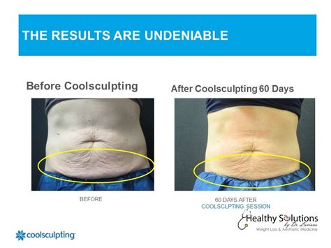 Coolsculpting Before And After Photos Cool Sculpting Coolsculpting