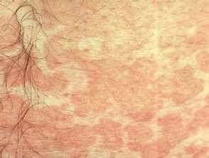 Pityriasis versicolor is not dangerous or contagious but causes cosmetic concerns in pityriasis alba. Pityriasis versicolor | DermNet NZ