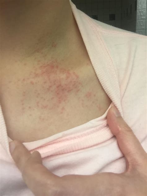 Do I Have Scabies This Itchy Rash Appeared On Me Overnight Scabies
