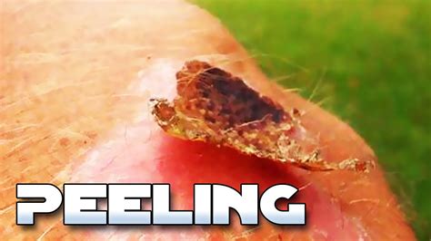 Picking And Peeling Scabs Educational Nsfe Youtube