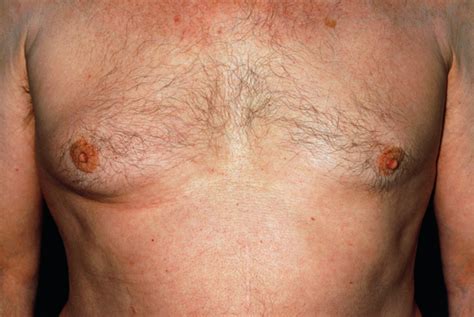 Male Breast Cancer Case Study GPonline