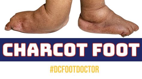 Charcot Foot A Devastating Condition Of Diabetes Youtube