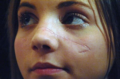 Figure Skater Jessica Dube Facial Scars Face Scars Female Character