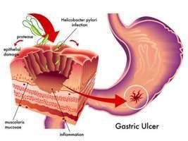 Perforasi Gastrointestinal Definisi Jenis Patofisiologi Komplikasi