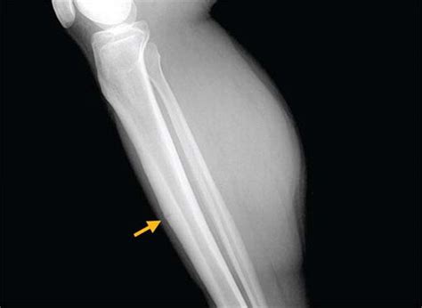 Identification Of A High Risk Anterior Tibial Stress Fracture Journal